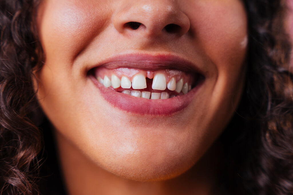 Diastema: causas, efectos y soluciones | Clínica Dental La Paz