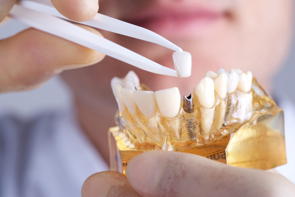 Implantes dentales de carga inmediata: restauración de la sonrisa en un solo día